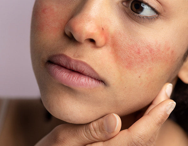 Understanding Rosacea: Causes, Triggers and Treatments