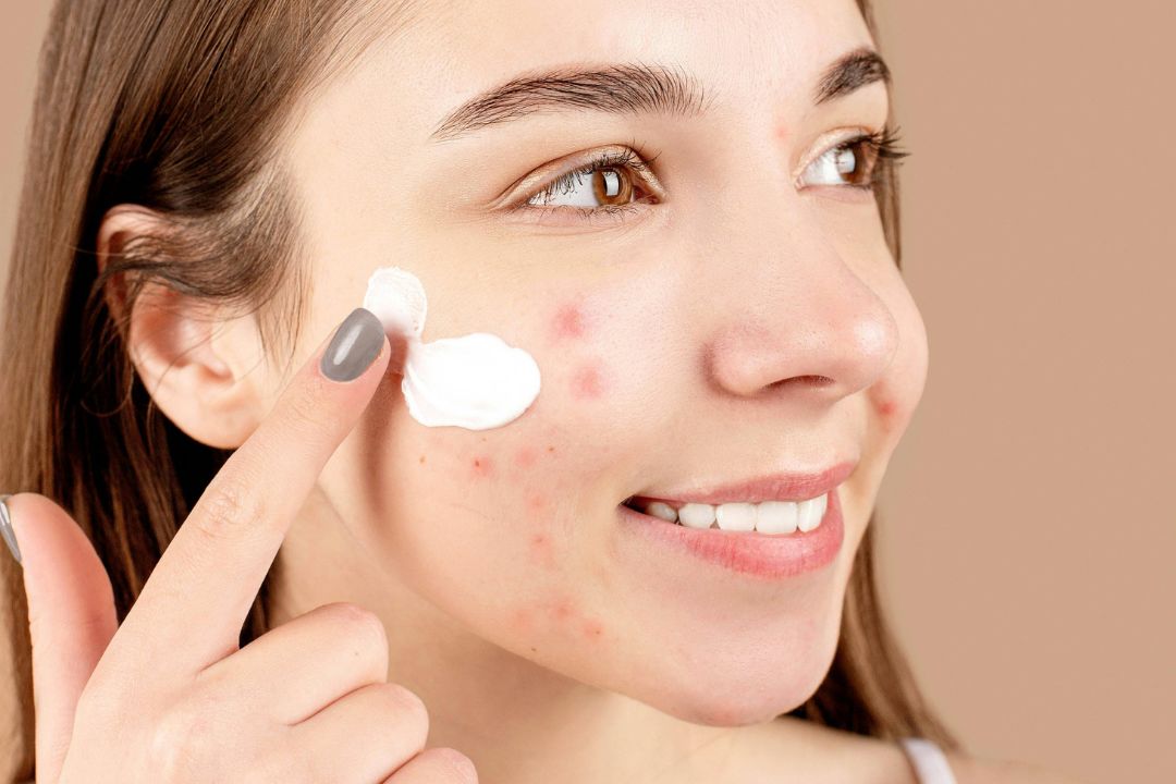 The Best SPF For Pimple Prone Skin