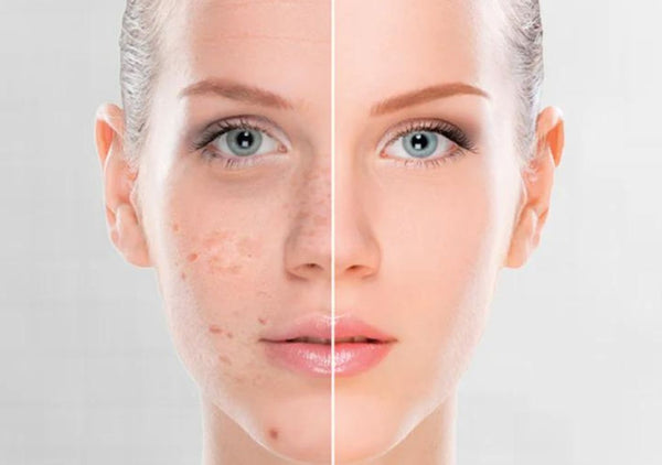 Fight Dark Spots With The Best Vitamin C Serum And Moisturisers For Hyperpigmentation
