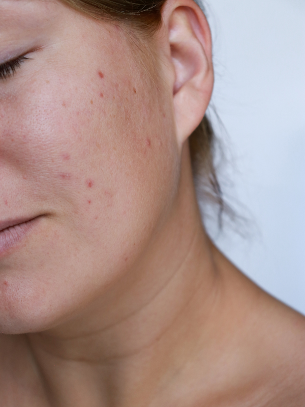 adult acne