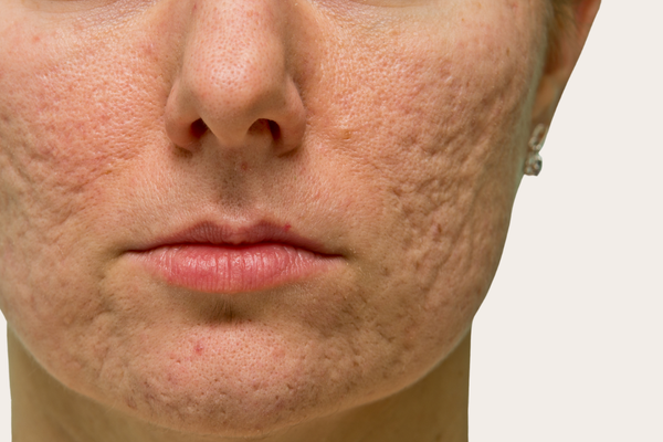 Can You Really Get Rid Of Acne Scars?