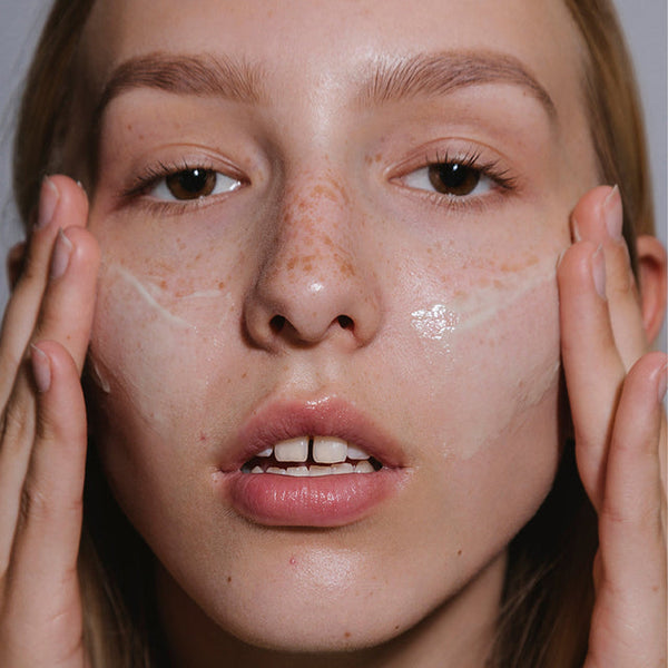 Adult hormonal acne on chin and jawline with inflamed breakouts and visible redness