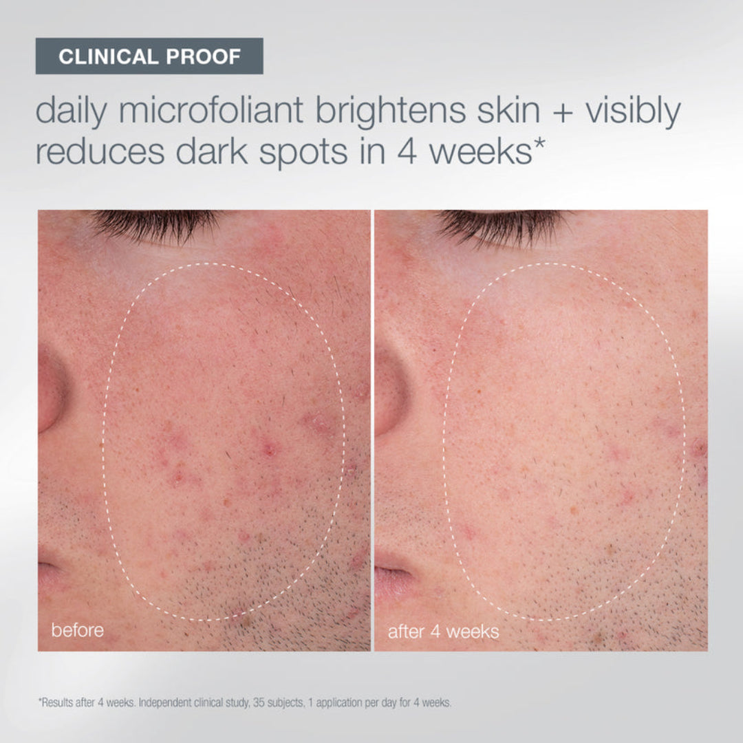 Before-and-after clinical skin comparison showing a person's cheek with acne and dark spots, labeled 'before' and 'after 4 weeks,' under the headline 'CLINICAL PROOF daily microfoliating brightens skin + visibly reduces dark spots in 4 weeks'.