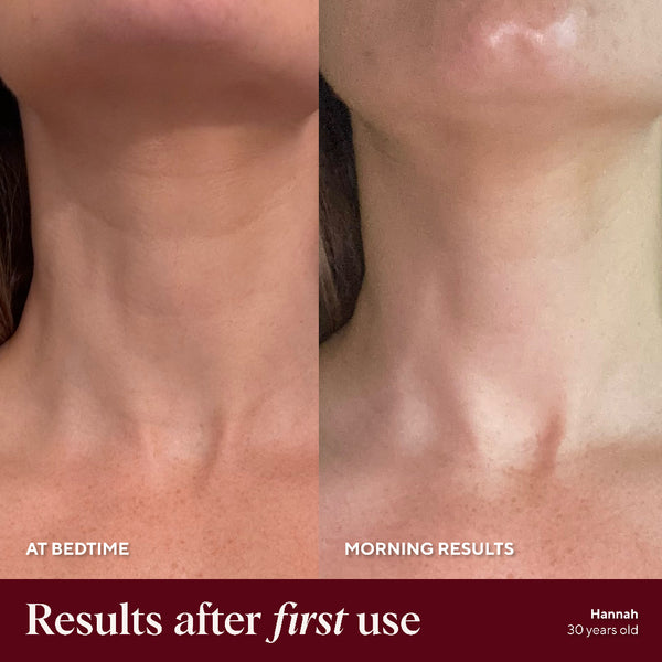 Before and after comparison of neck skin texture with text indicating 'Results after first use' and 'Hannah 30 years old'.