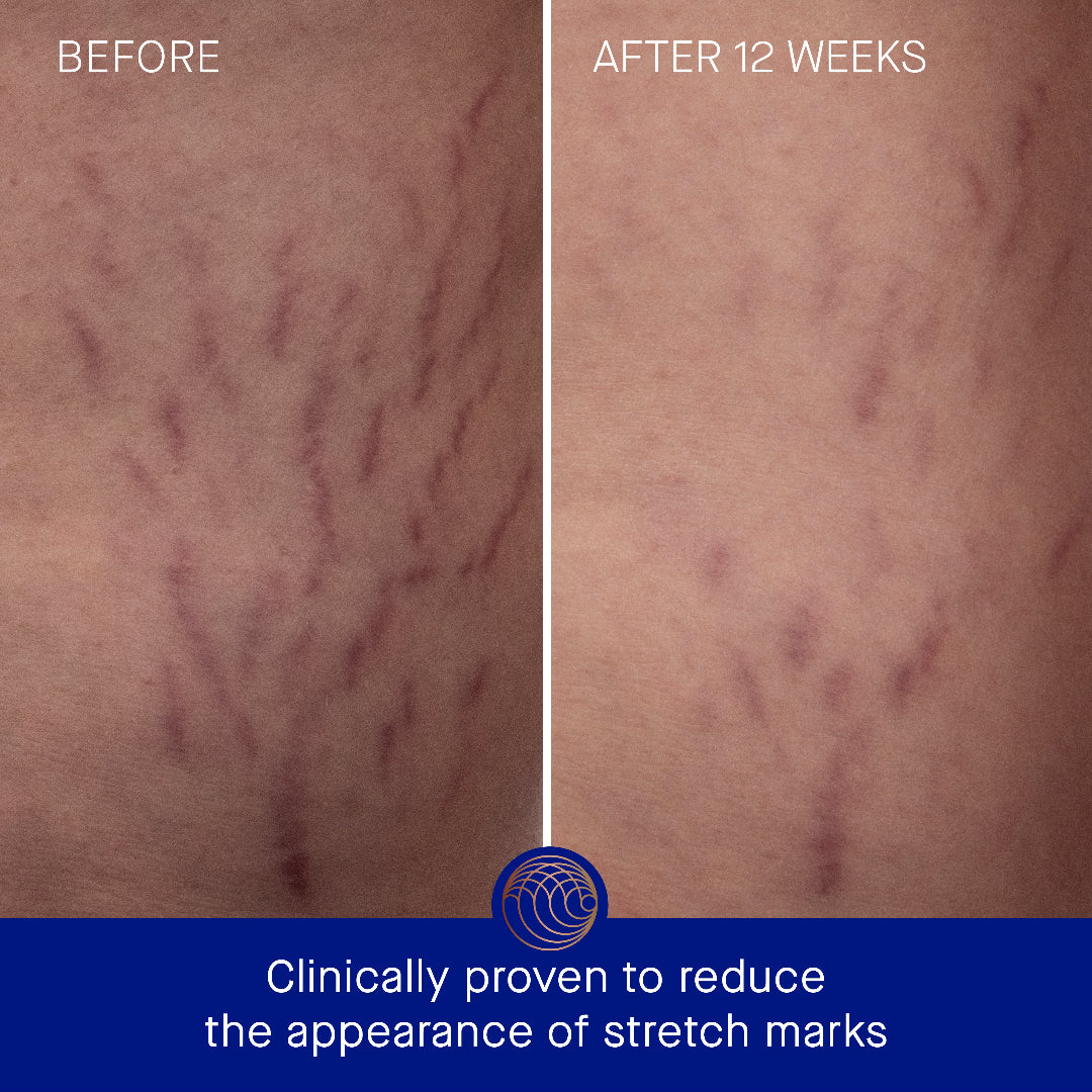 Before and after comparison of stretch marks on skin with a blue banner at the bottom.