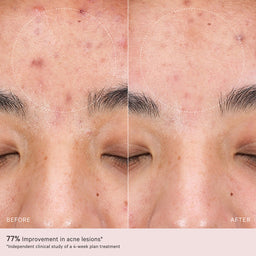 MZ SKIN LED 2.0 LightMAX Supercharged LED Mask