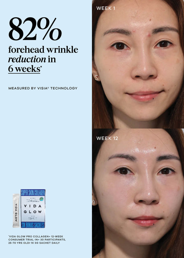 Before and after comparison of a woman's face with Vida Glow product, showing forehead wrinkle reduction over 12 weeks.