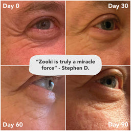 Before and after comparison of eye area over 90 days with Zooki product.